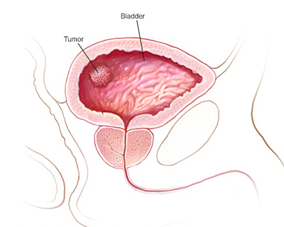 Bladder Cancer Treatment