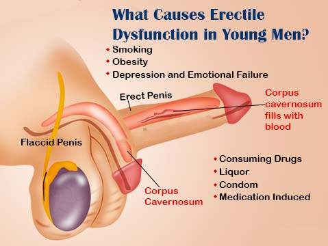 Erectile Dysfunction