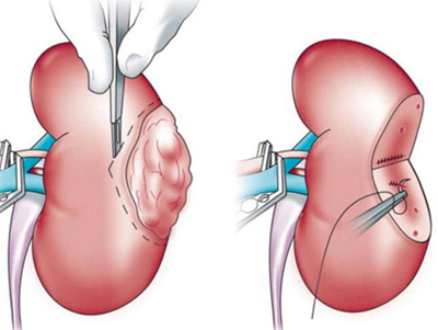 Kidney Cancer