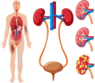 Kidney Transplant