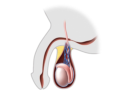 Urethral Stricture