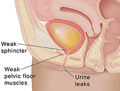 Urine Leak