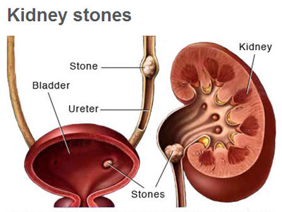 Kidney Stone Treatment